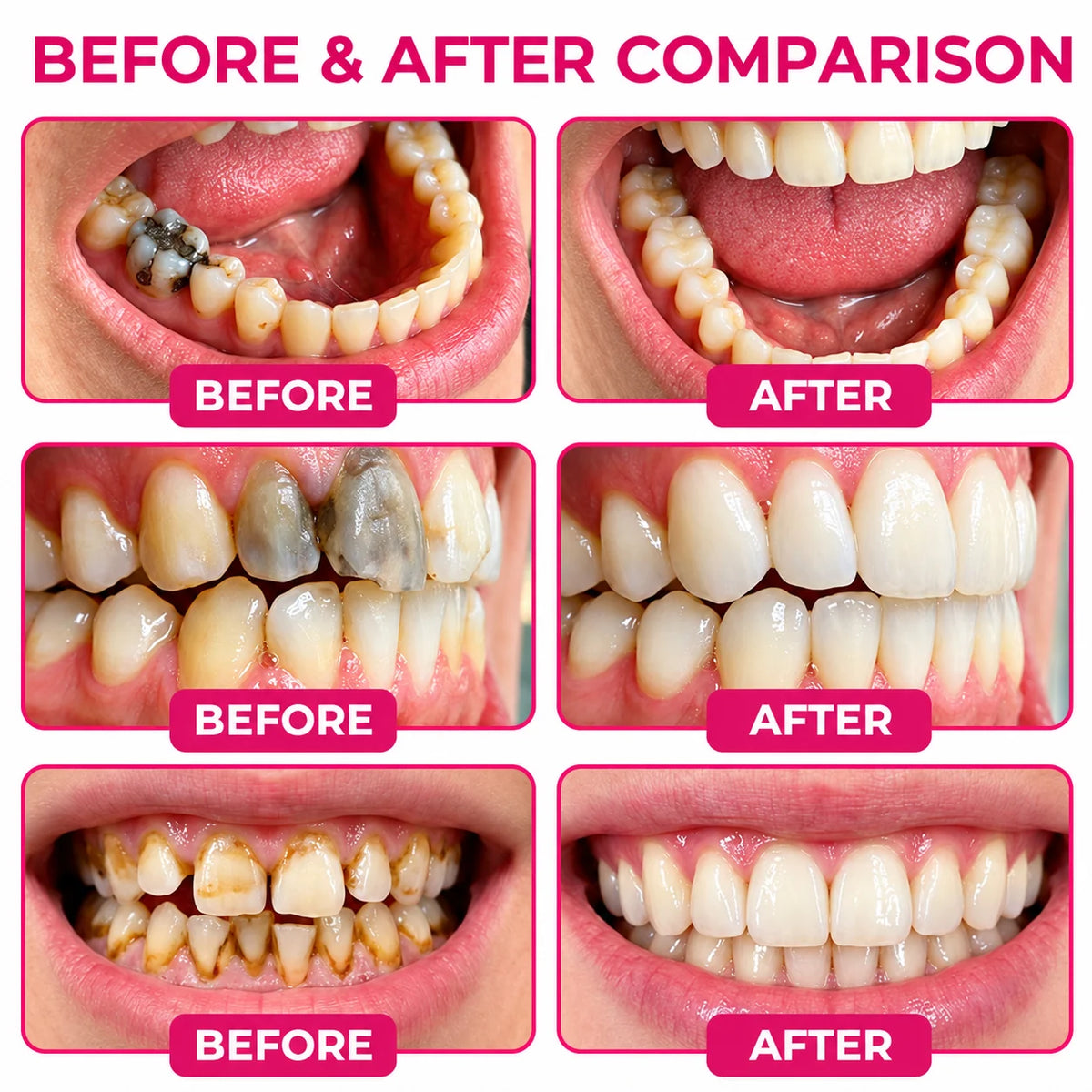 DenPerm Cavity-Repair Natural Enamel Filling Gel